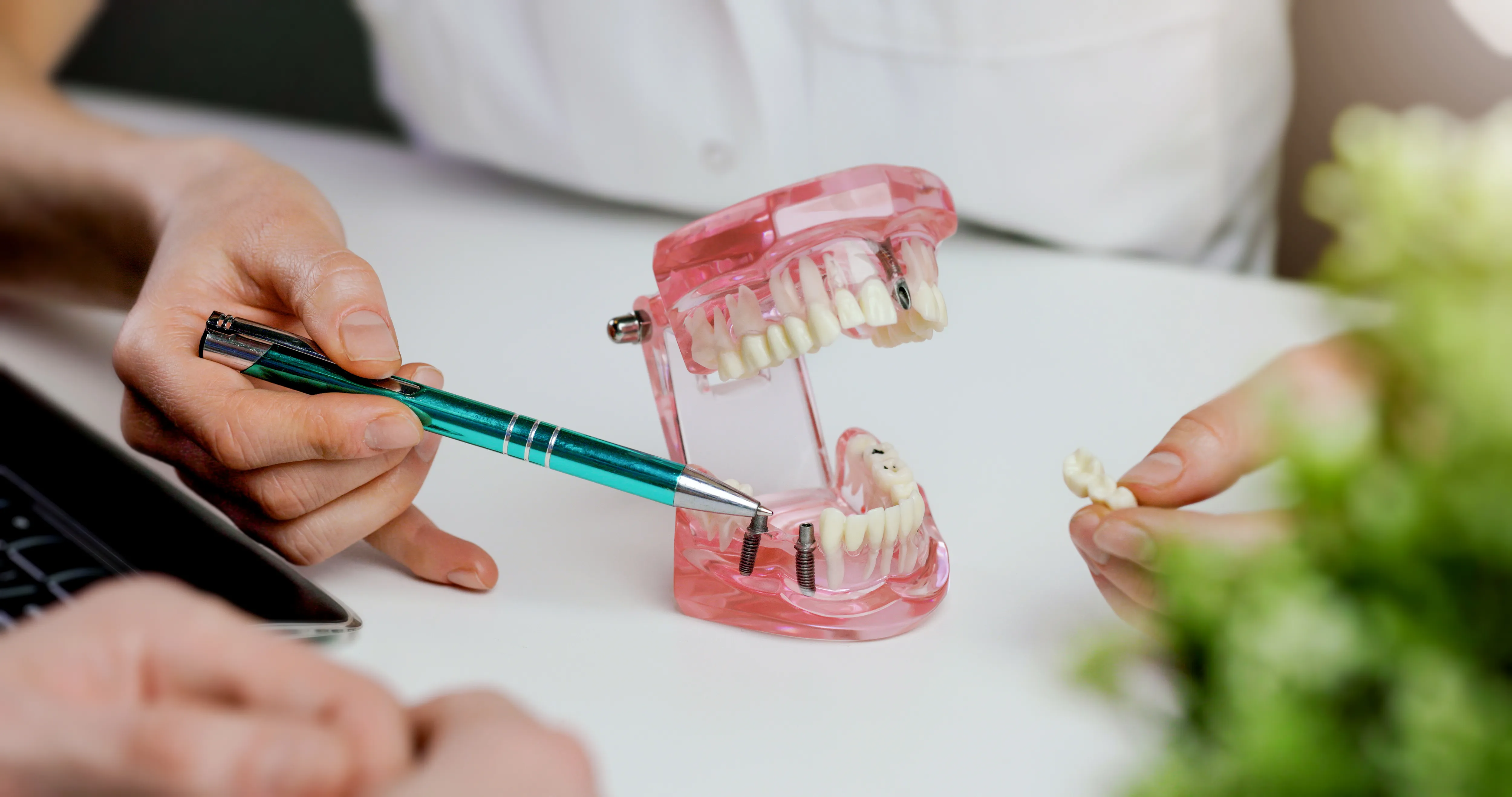 A dentist explaining dental implants using a dental model during a consultation