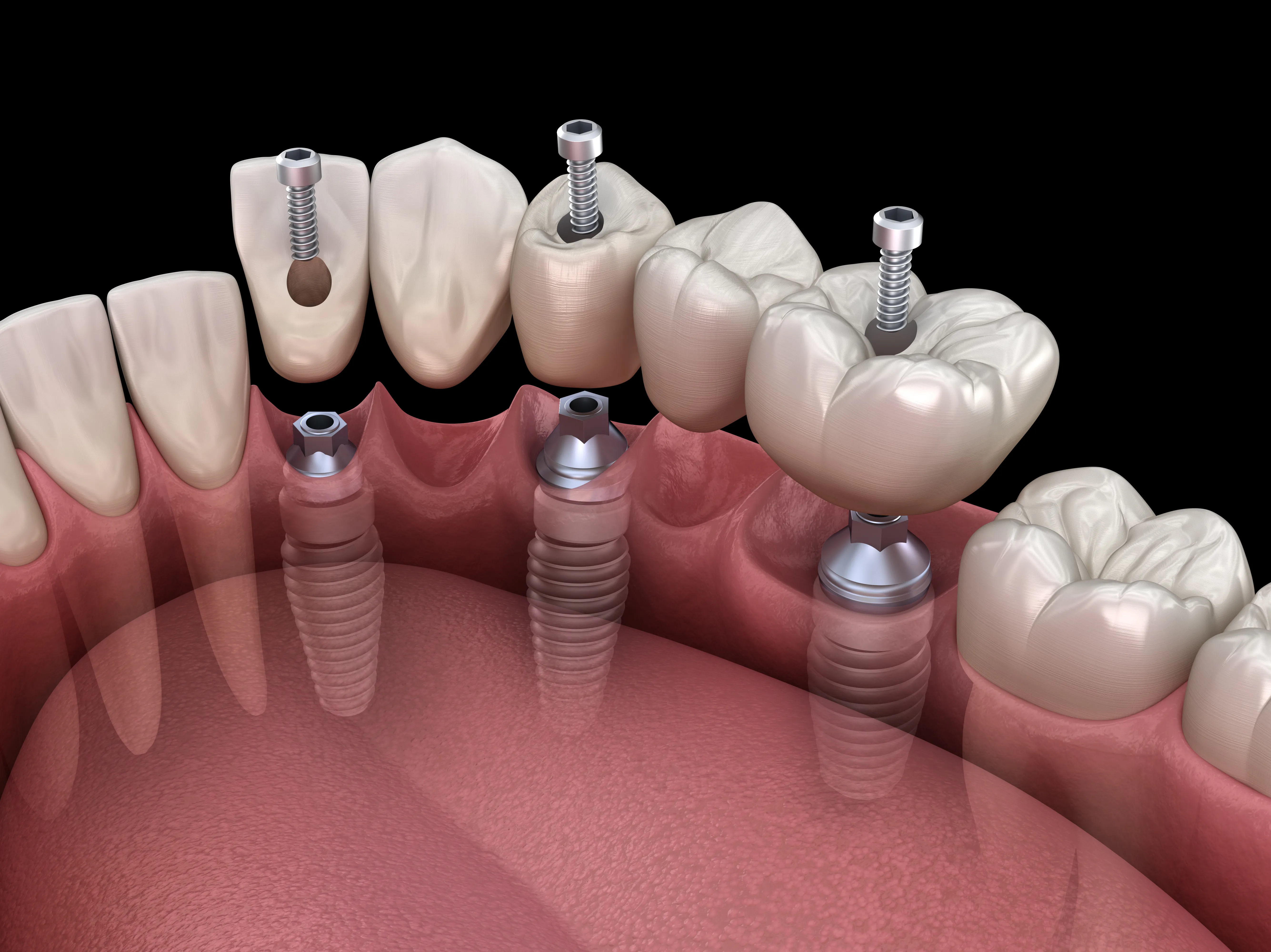 3D illustration of an implant-supported bridge replacing three lower back teeth on dental implants