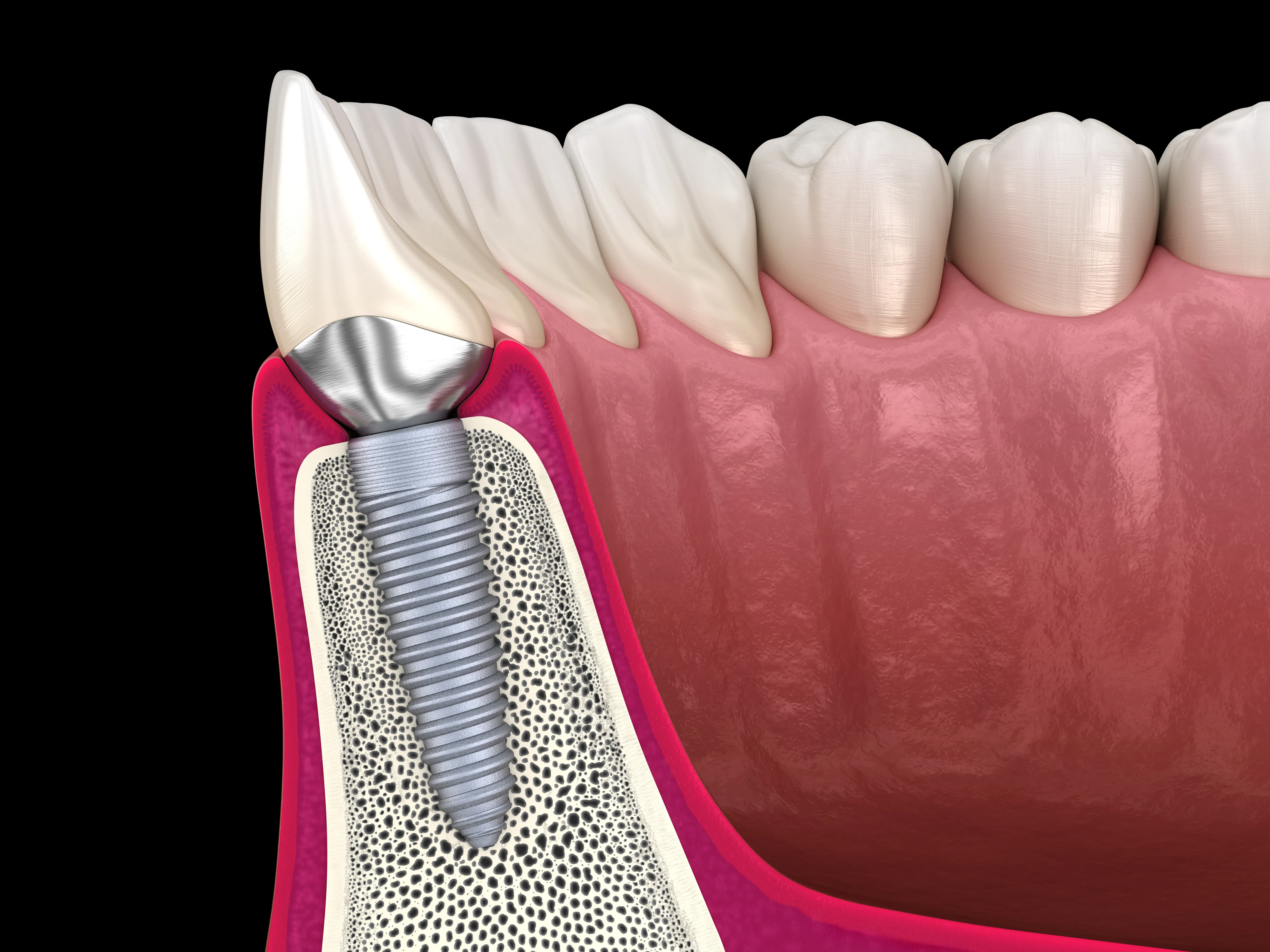 Cross-section 3D illustration of a single dental implant integrated into the jawbone beneath a crown