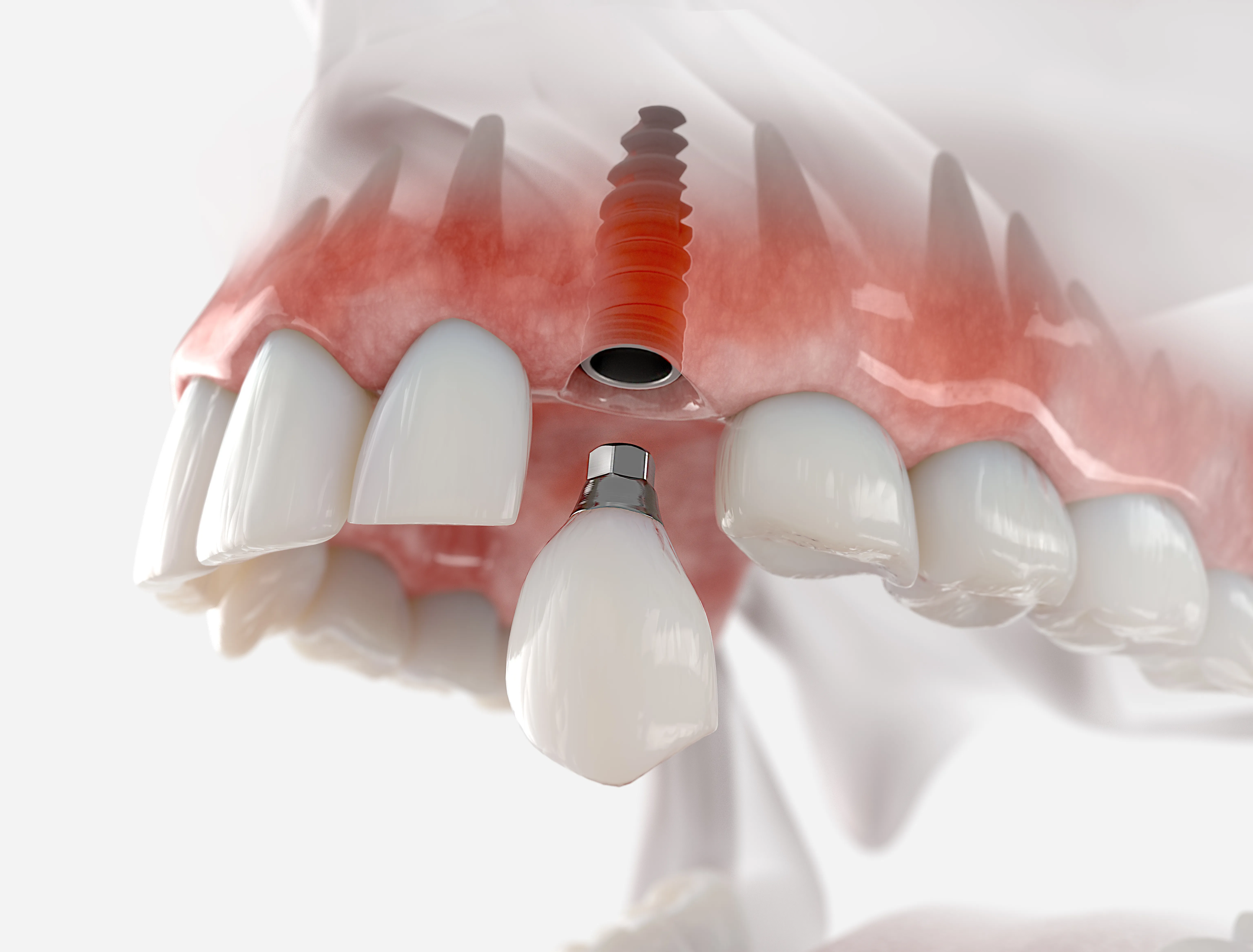 Cross-section illustration of a single upper-jaw implant with a crown being placed onto the abutment