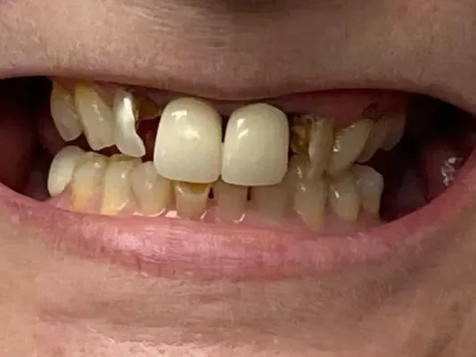 Before treatment: discolored, uneven, and worn front teeth with visible staining