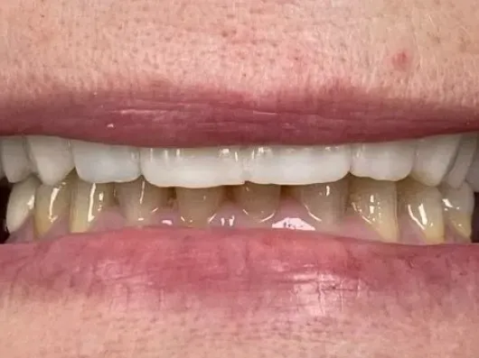 After treatment: brighter, even front teeth following cosmetic restoration