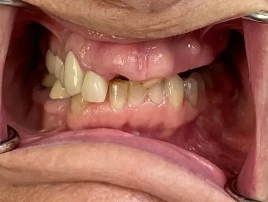 Before treatment: a retracted view showing gapped and missing upper teeth and worn lower teeth