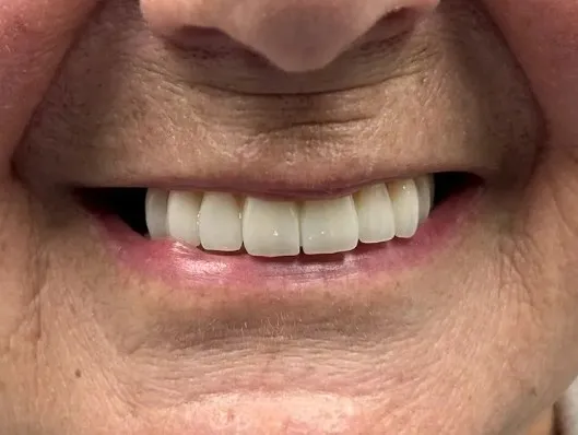 After treatment: a complete, even smile with full upper and lower teeth restored