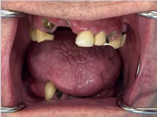 Before treatment: severe tooth loss with only a few broken, decayed teeth remaining on the upper and lower arches