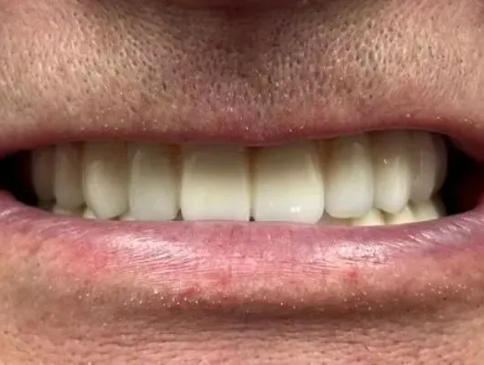 After treatment: a full restored arch of even, natural-looking teeth