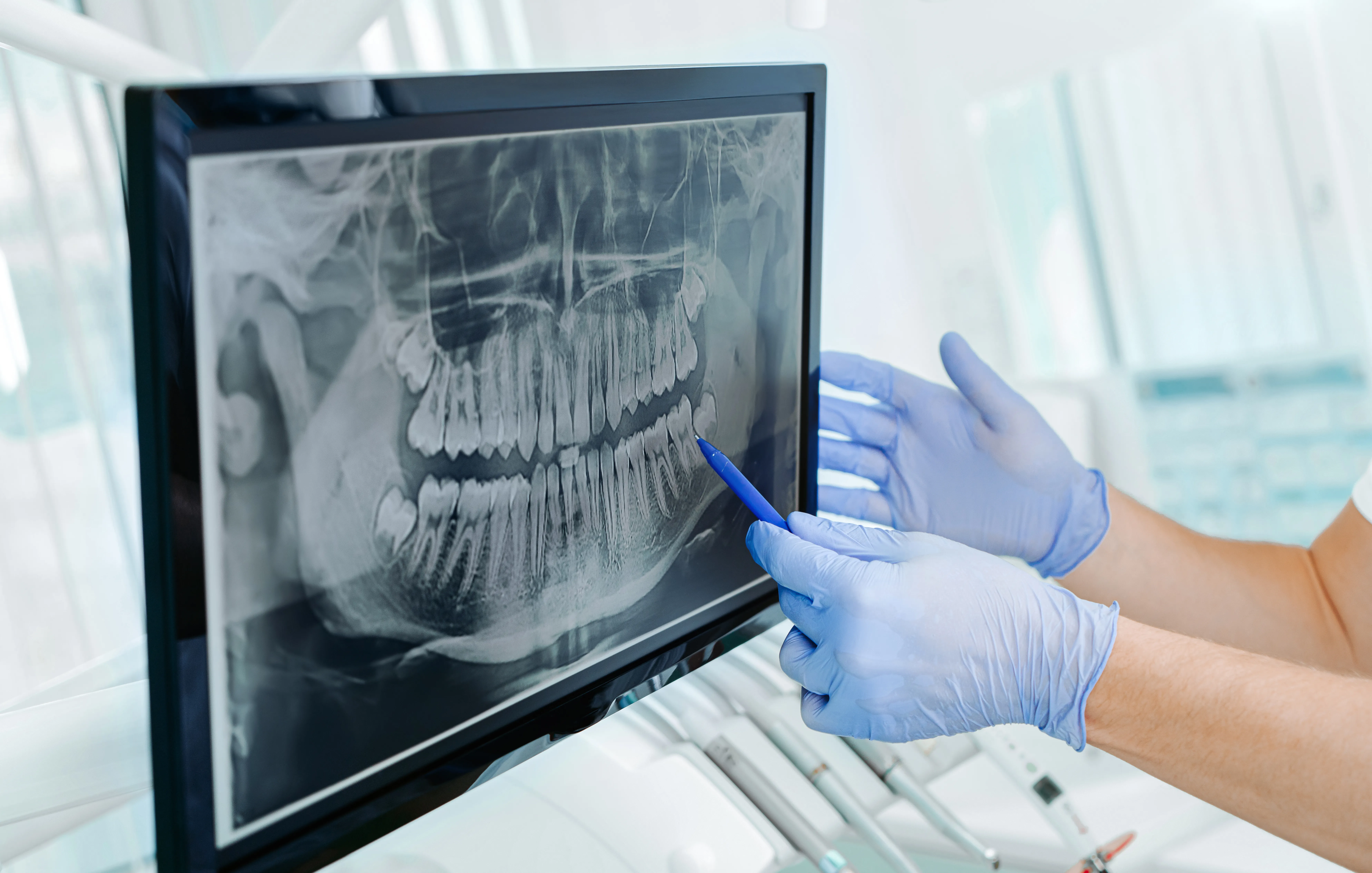 Gloved dentist pointing to a panoramic dental X-ray displayed on a monitor
