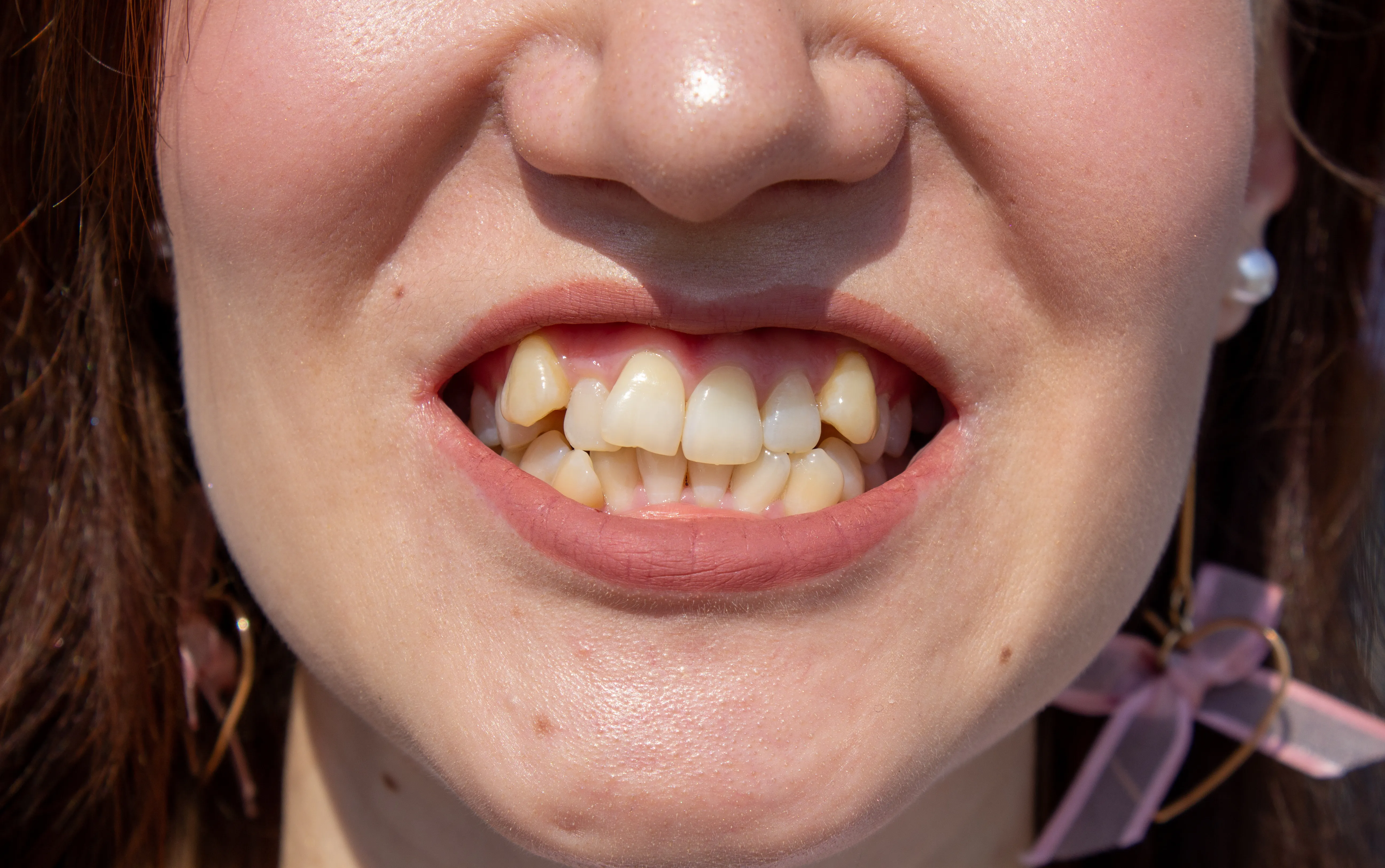Close-up of a woman's lower face showing crowded, crooked front teeth before orthodontic treatment