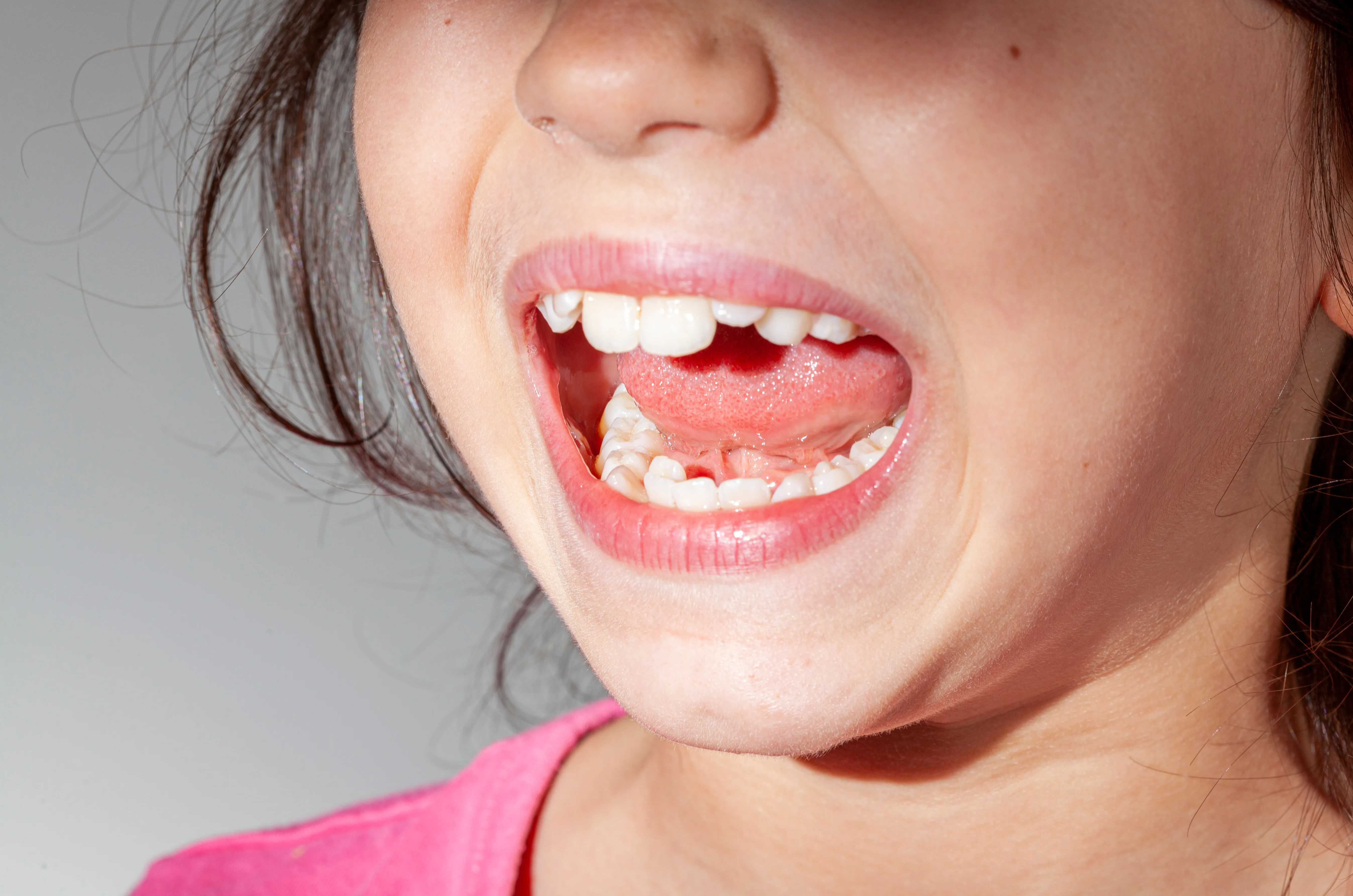 Close-up of a young girl's open mouth showing crowded mixed teeth and a gap from a missing tooth