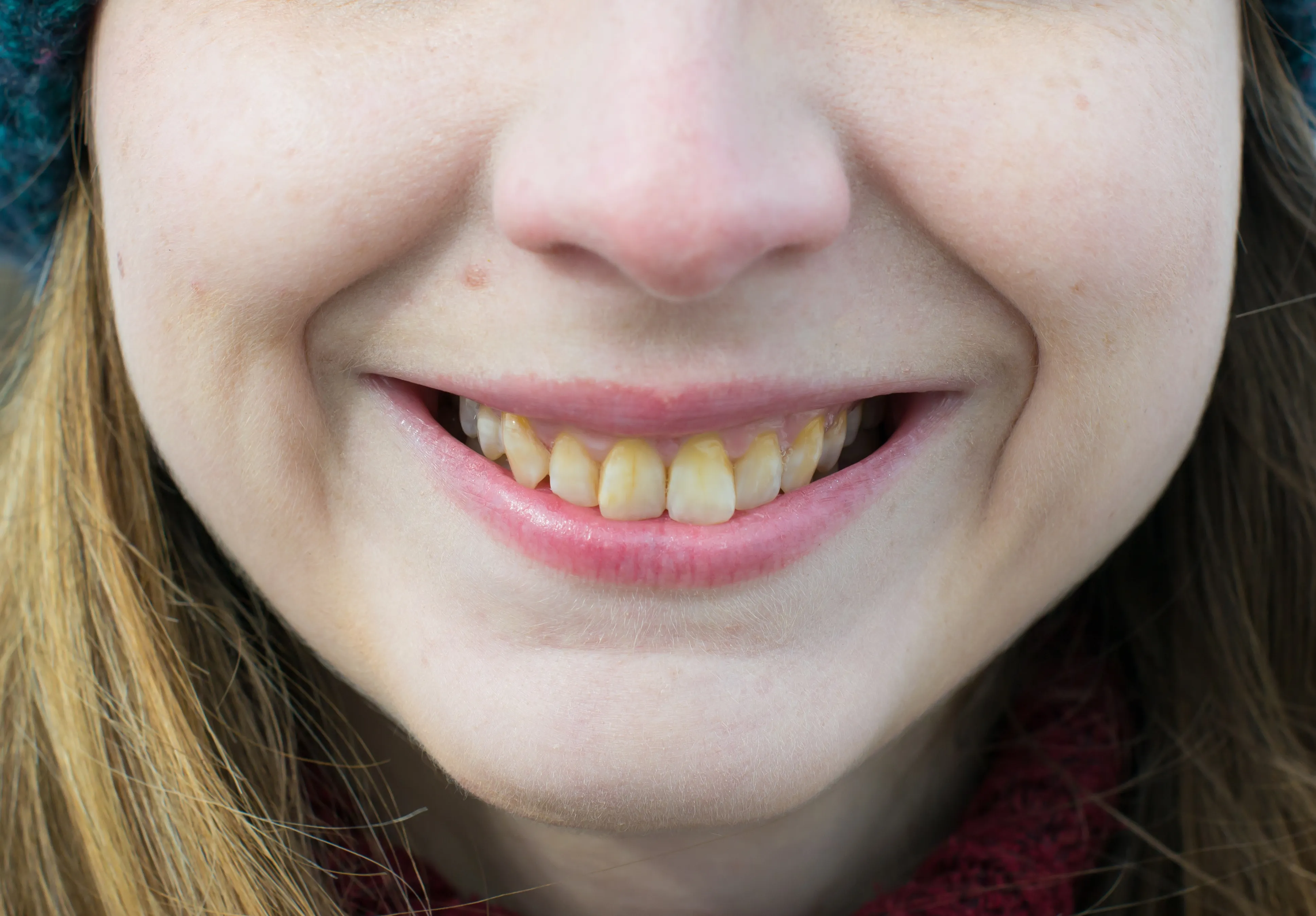 Close-up of a woman's smile showing slightly crooked, yellow-tinged teeth before whitening