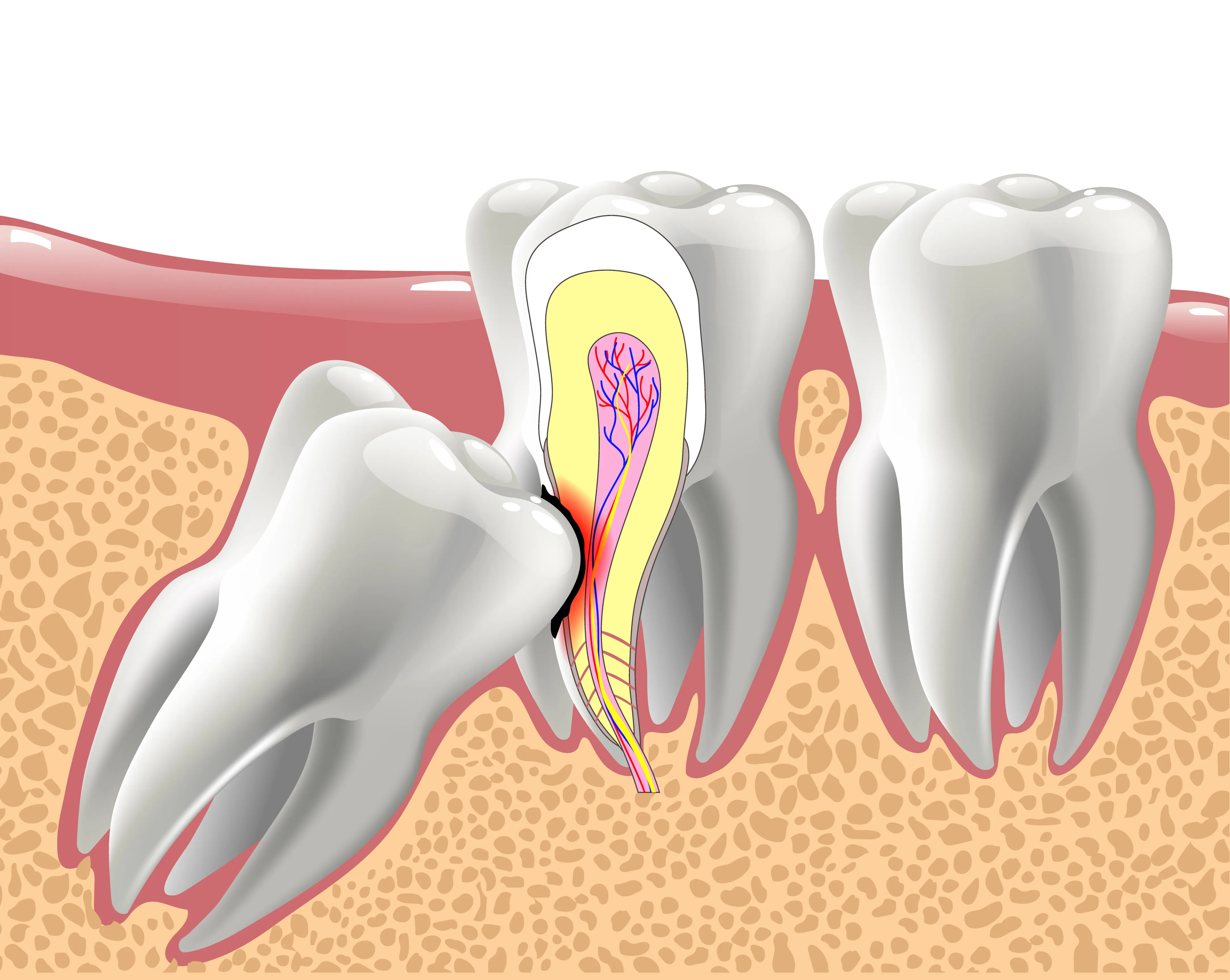 Cross-section illustration of an impacted wisdom tooth angled against the molar beside it