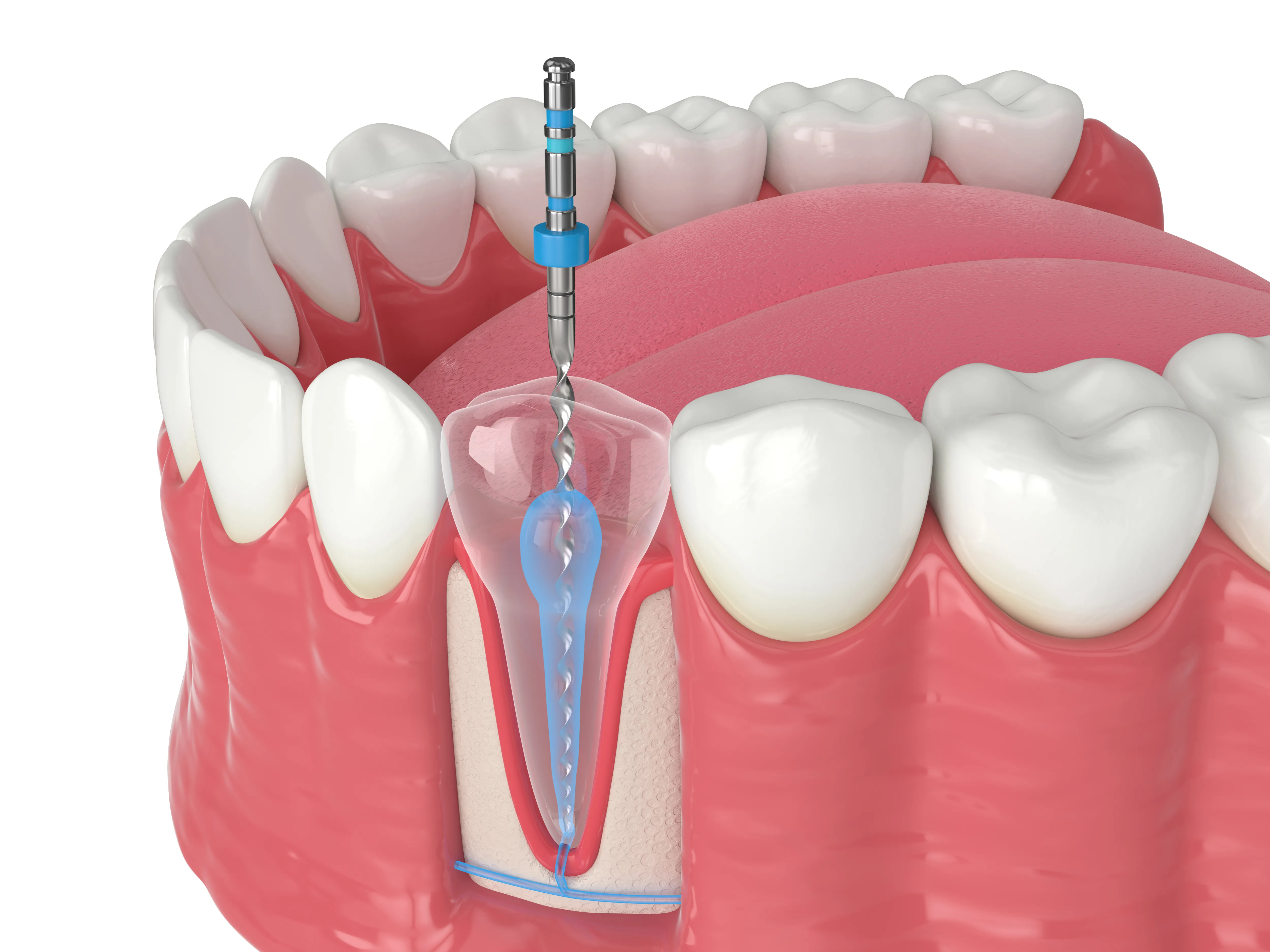 Close-up inside an open mouth showing color-coded endodontic files placed in a back tooth during root canal treatment