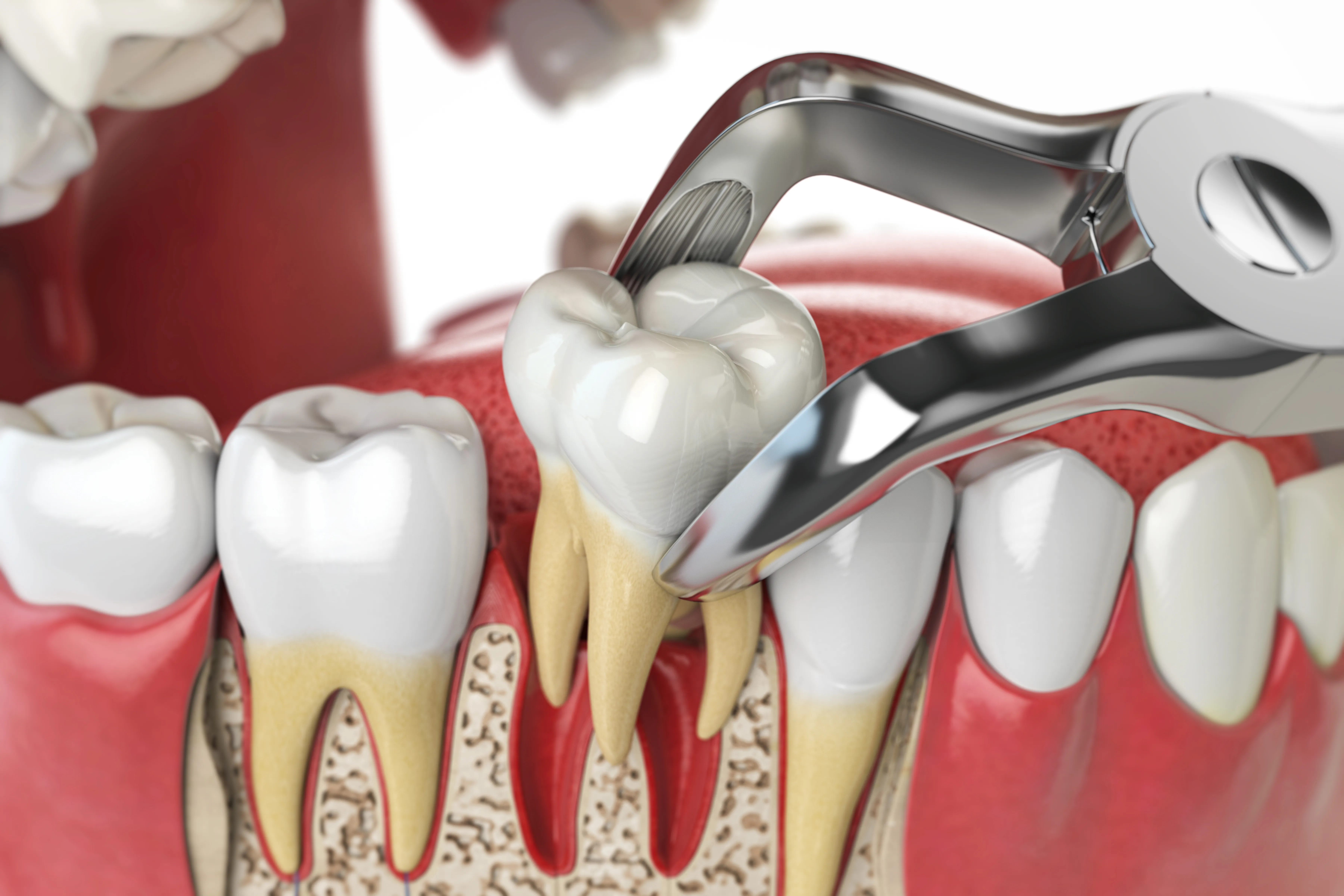 Close-up of dental forceps gripping a tooth root at a gap in the upper front teeth during an extraction