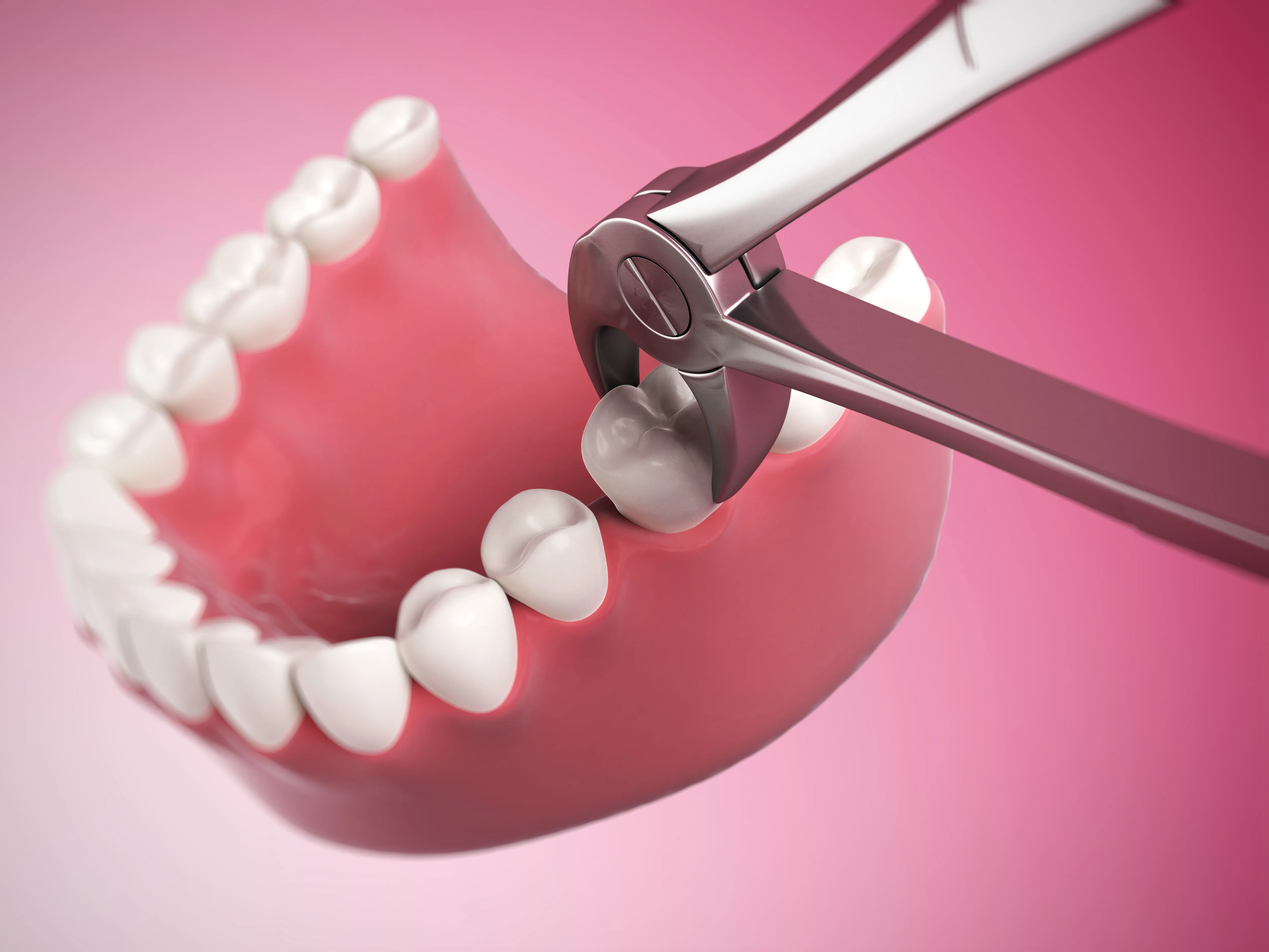 Extracted teeth resting on gauze beside dental forceps and a mouth mirror on a white surface