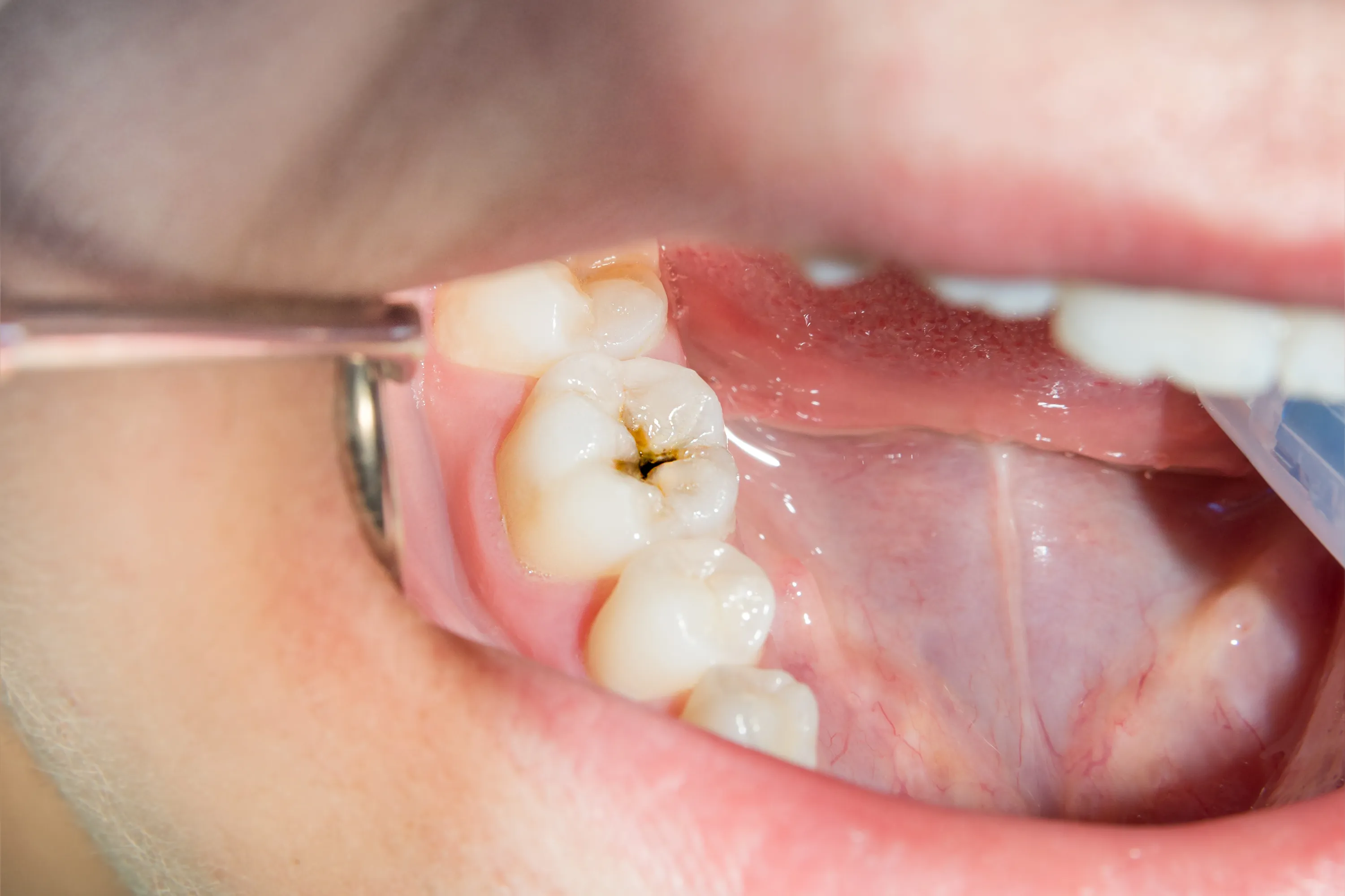 close-up of a human rotten carious tooth at the treatment stage in a dental clinic