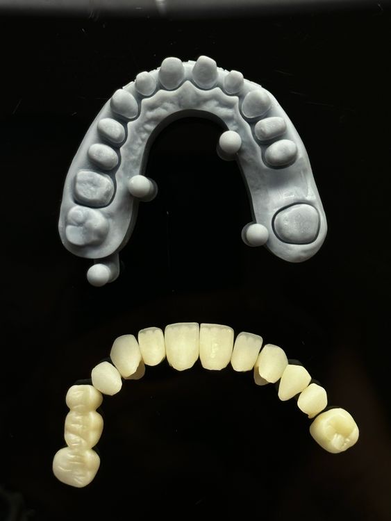 Dental crown and prosthetic tooth models displayed on a dental cast