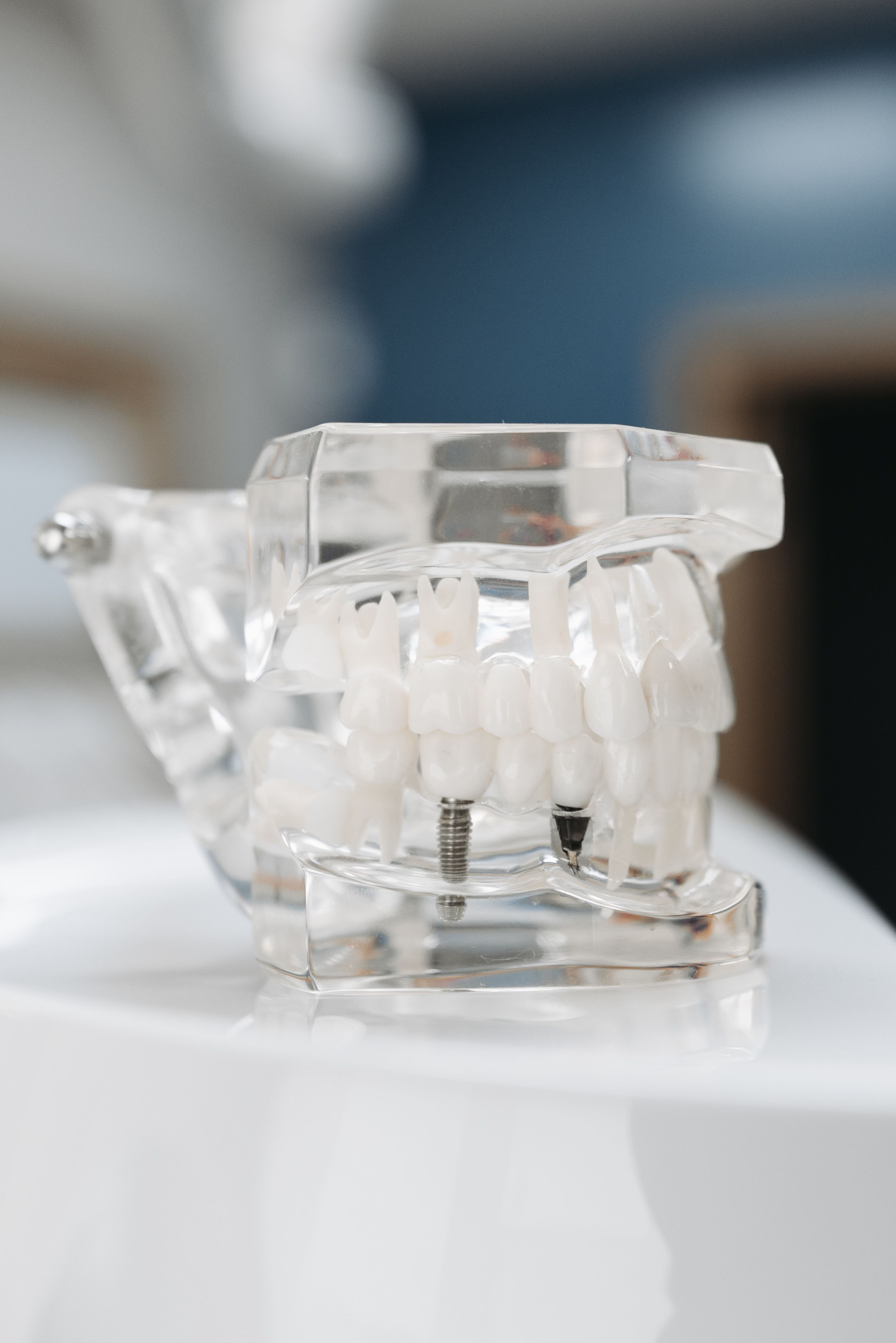 Transparent dental model showing implant posts anchored in the jawbone