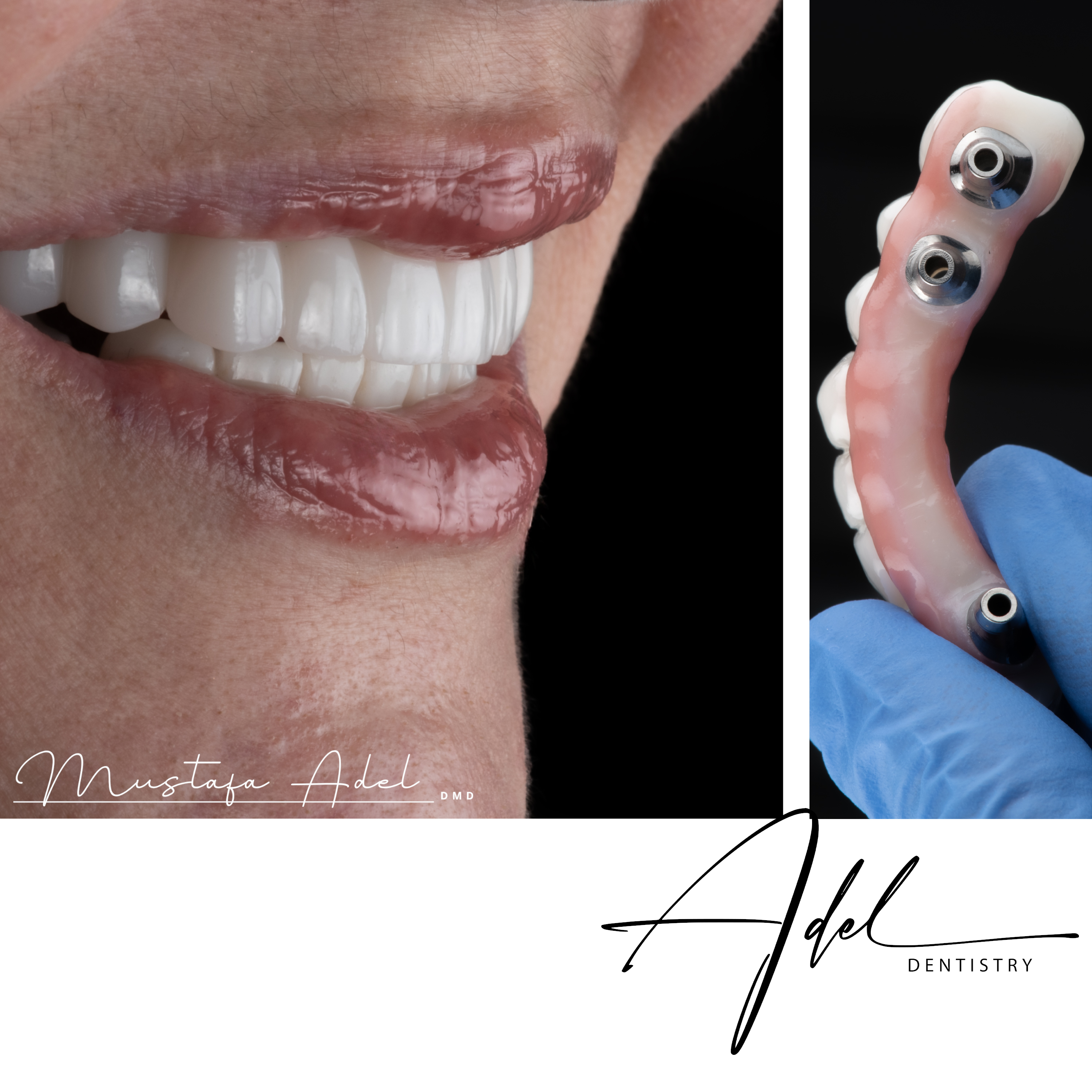 Implant Case
