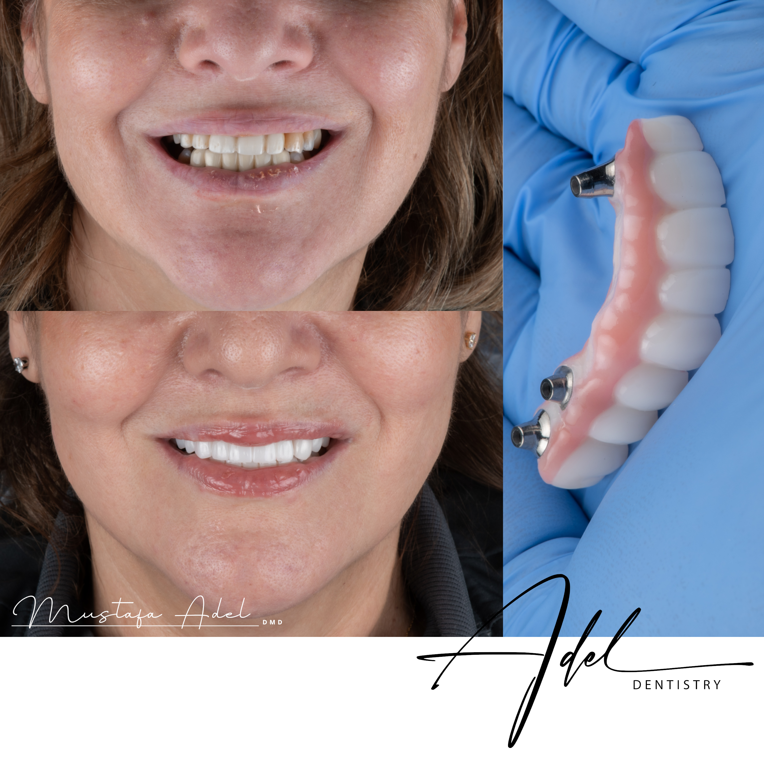 Implant Restoration