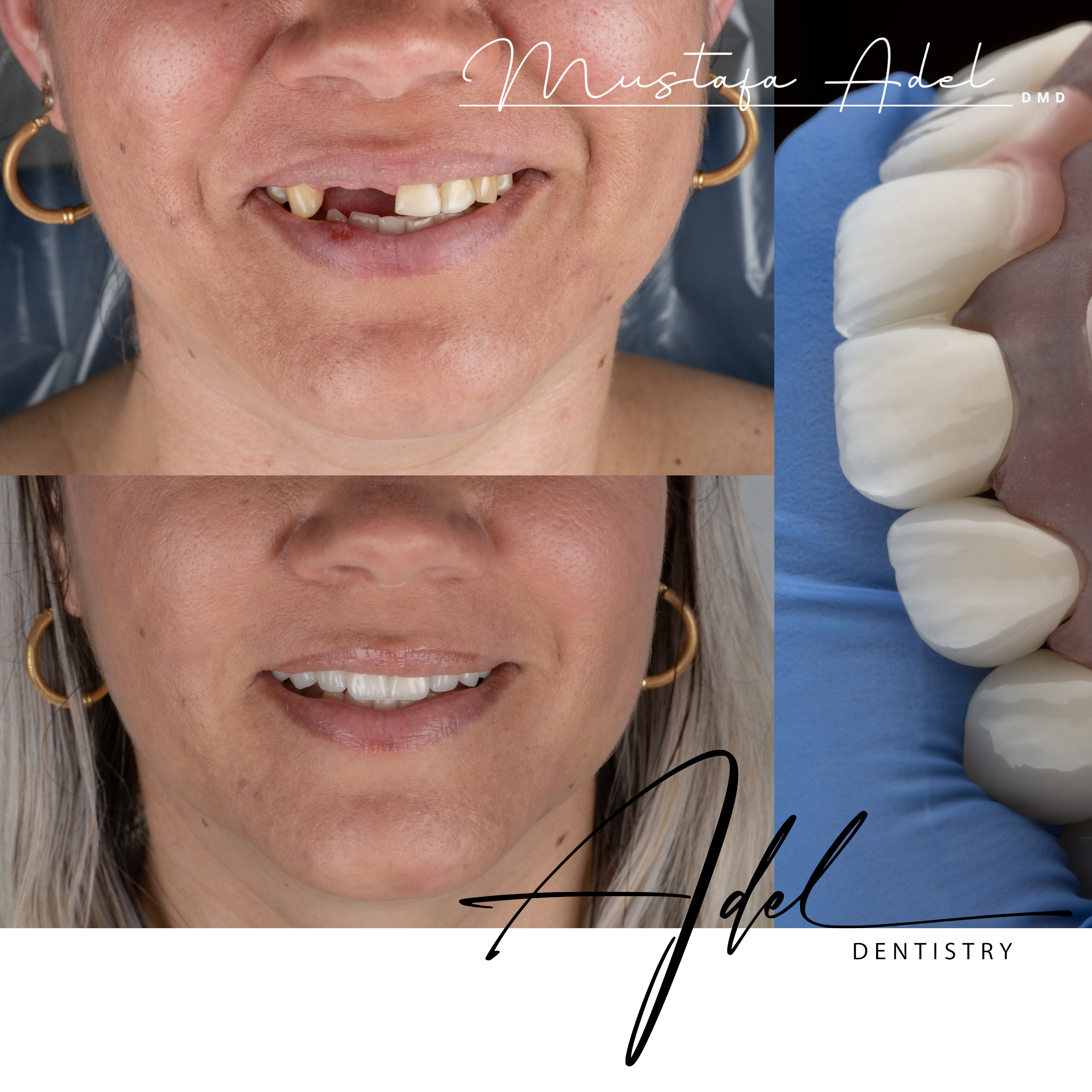 Smile Makeover
