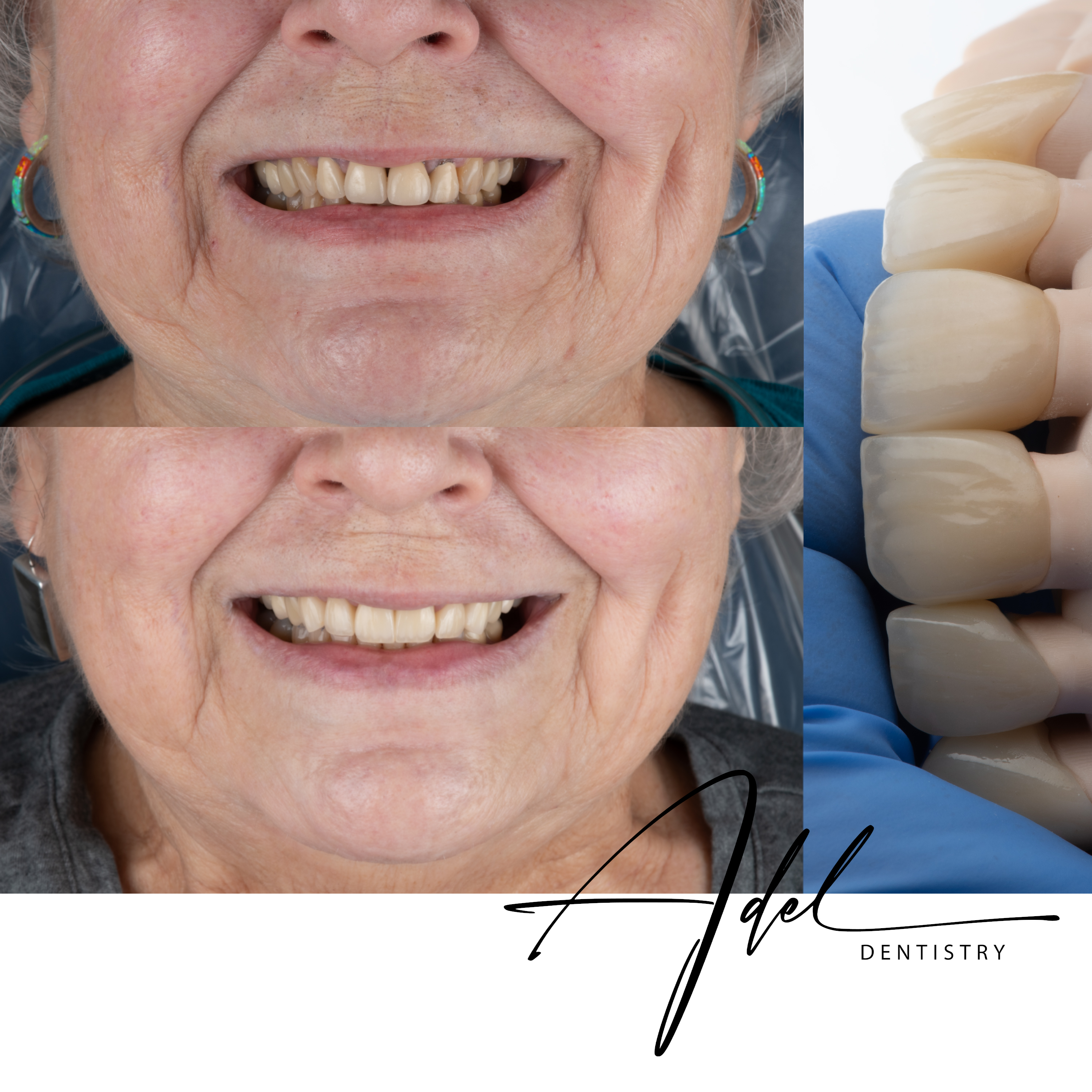 Gum Contouring + Veneers