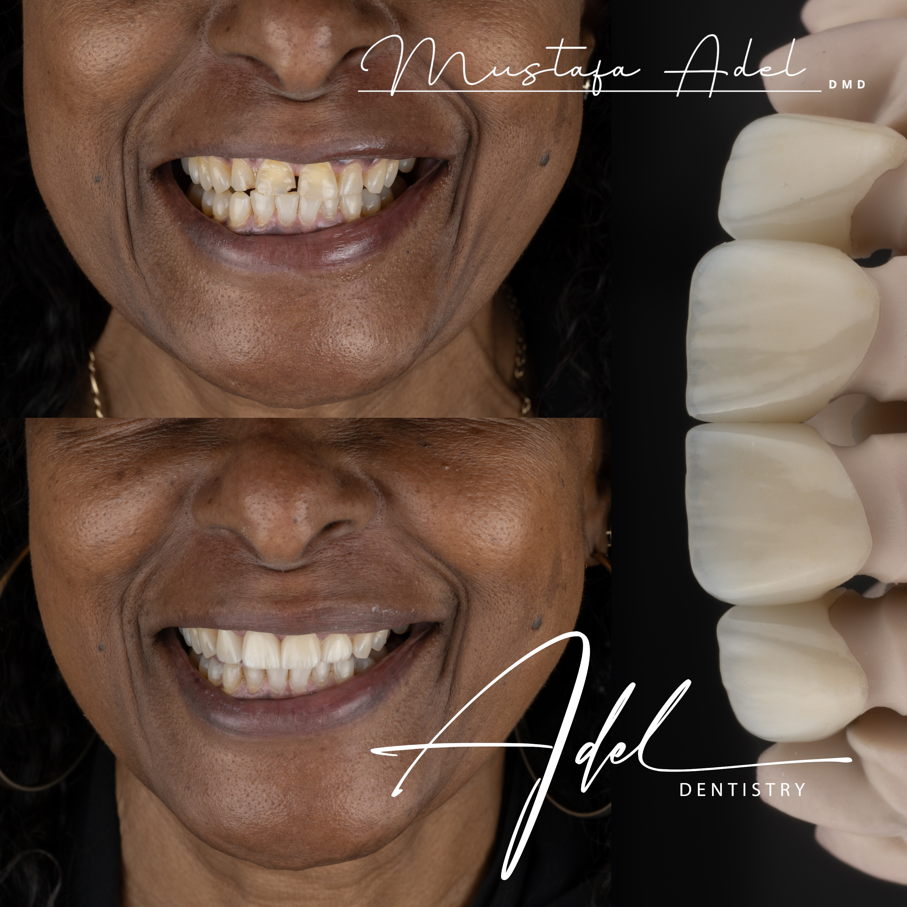 Full Smile Makeover