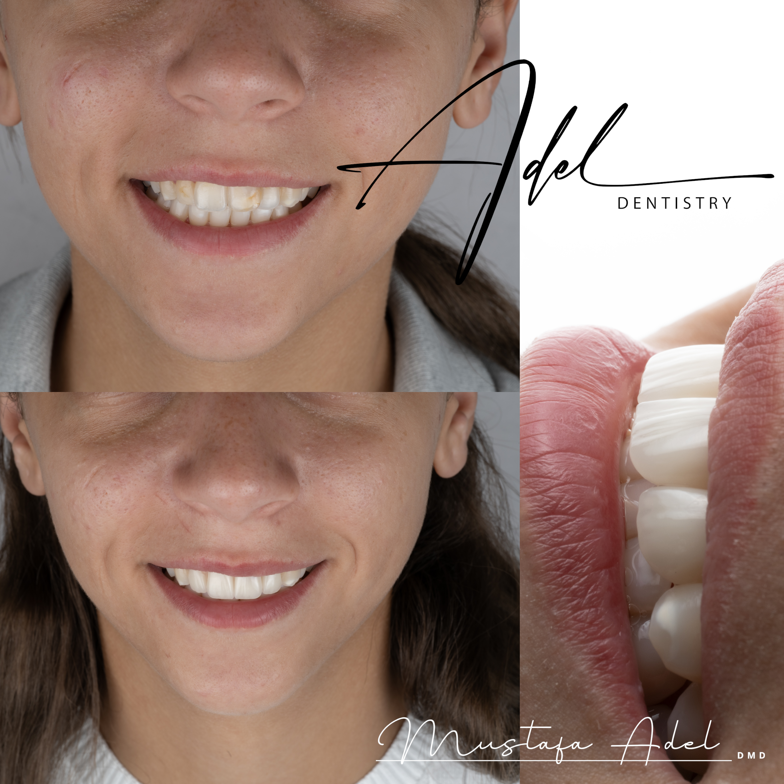 Worn Dentition Repair