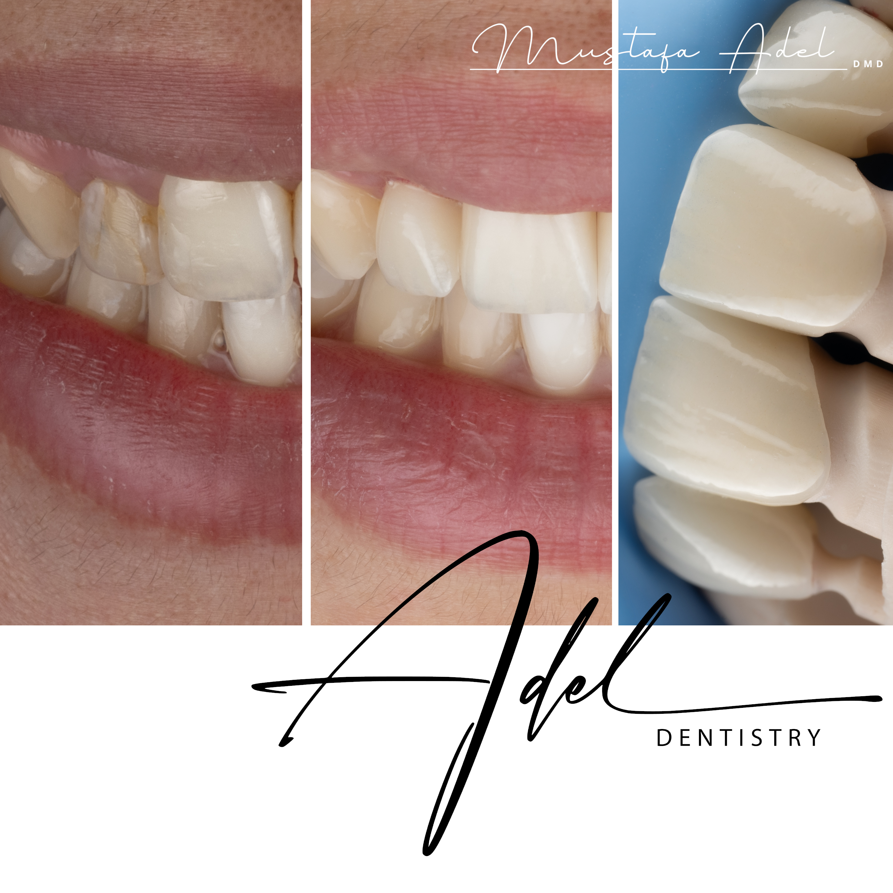 Porcelain Veneers