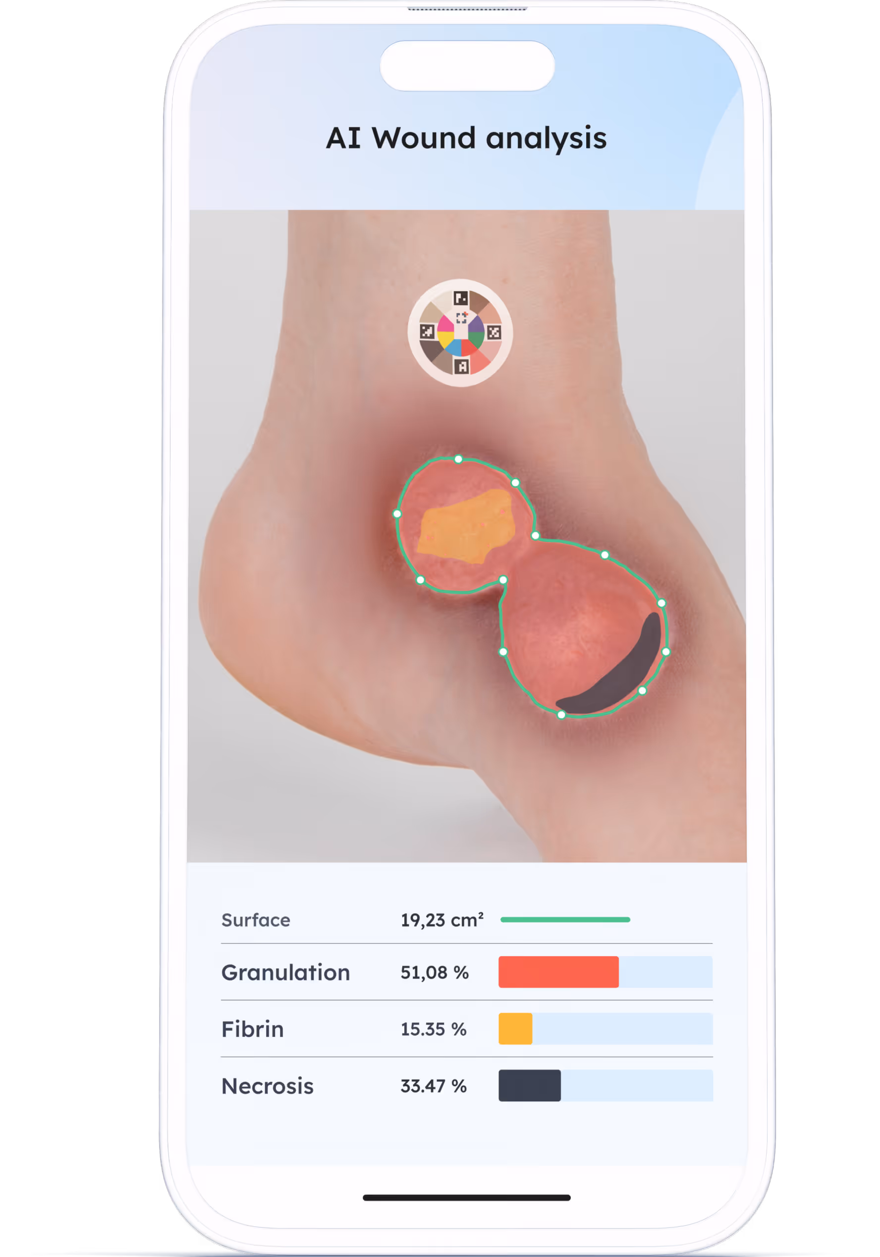 Pixacare Device mockup #2 – wound monitoring dashboard with AI measurement on smartphone