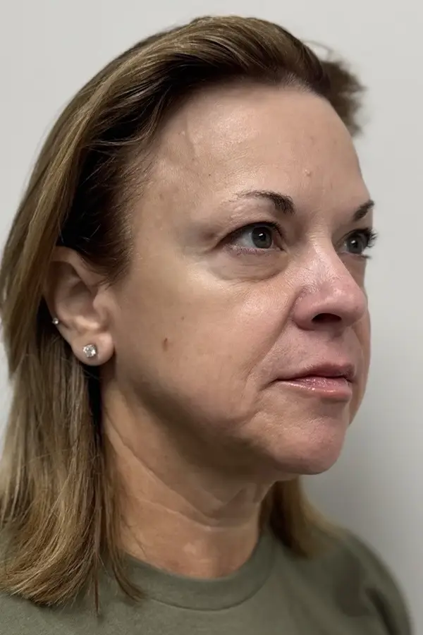 Before midface filler at CAMI — flat cheeks, soft jawline, and reduced lower face structure