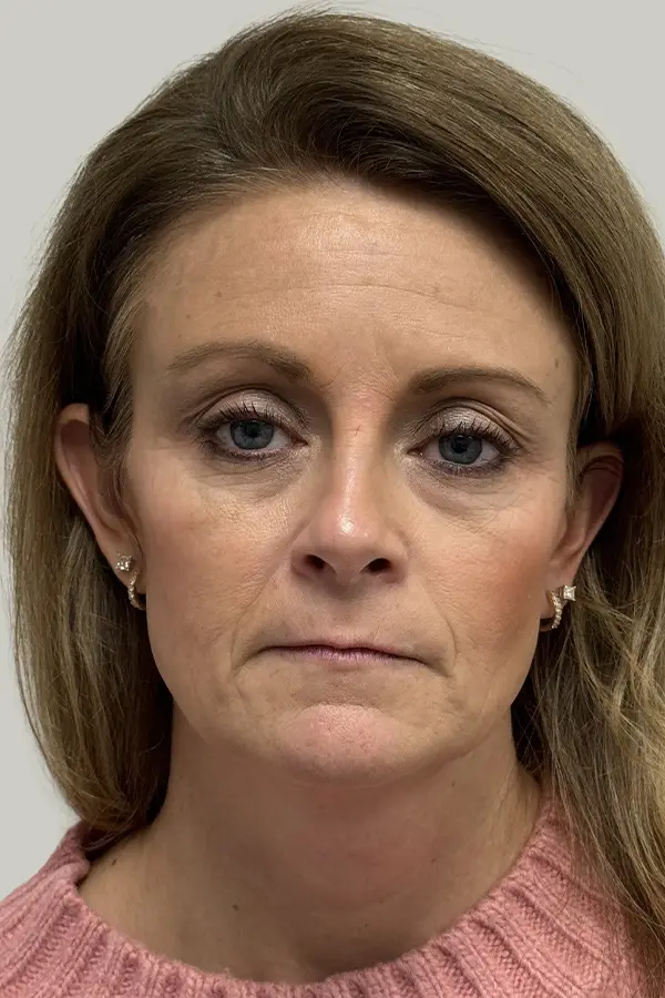 Before wrinkle relaxers at CAMI — crow's feet, frown lines, and forehead expression lines present at rest