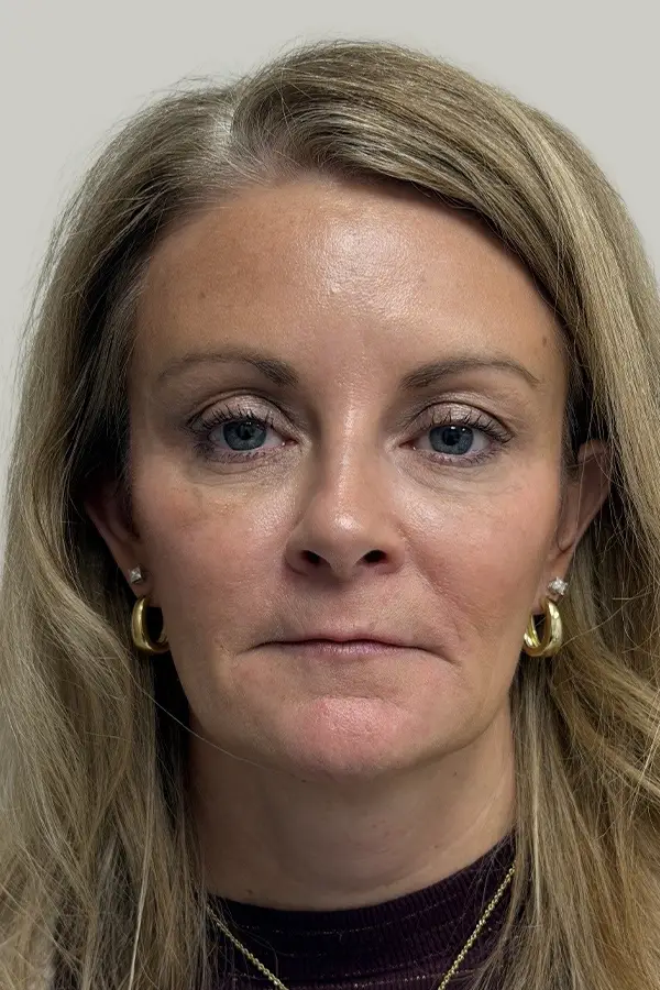 After wrinkle relaxers by Ashley Roberts RN at CAMI — softened crow's feet, frown lines, and forehead lines