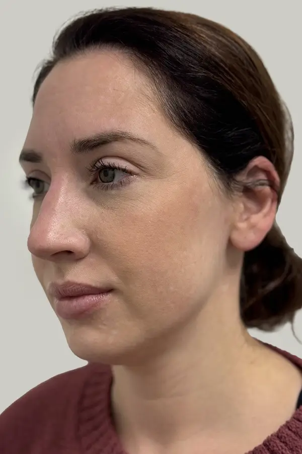 ashley-lowerfacefiller