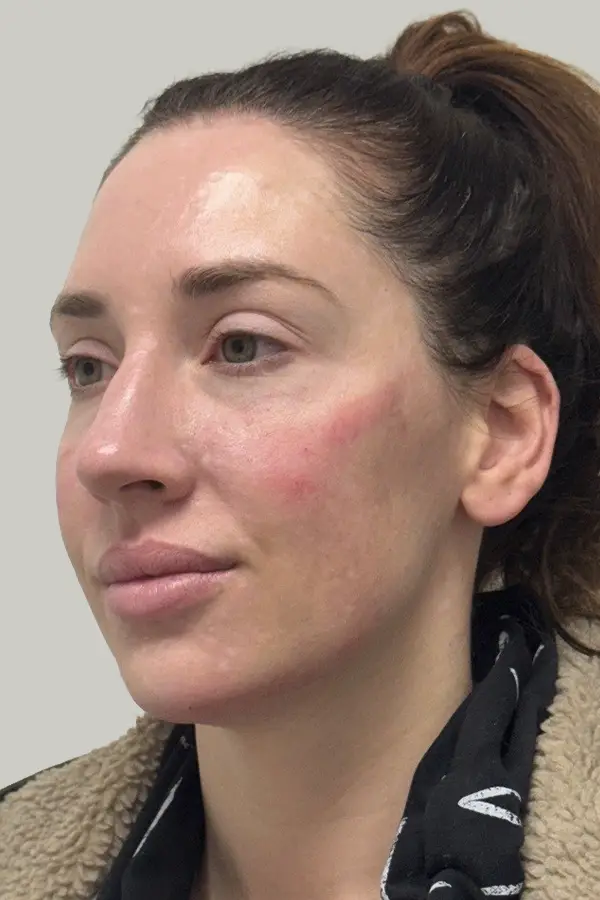 After lower face filler by Ashley Roberts RN at CAMI — defined jawline, improved chin projection, and restored cheek structure