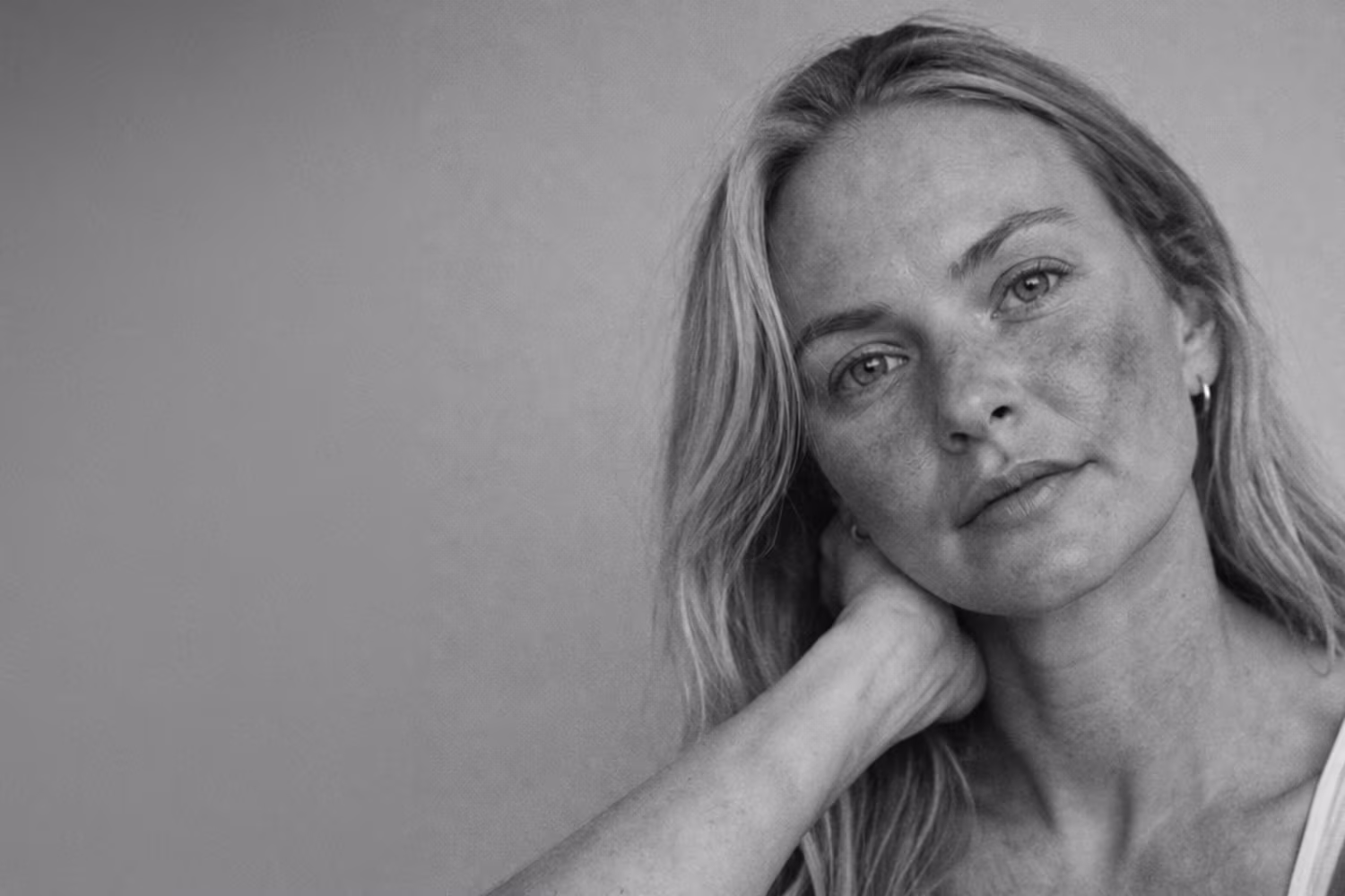 Black and white portrait representing rosacea and chronic facial redness concern at CAMI