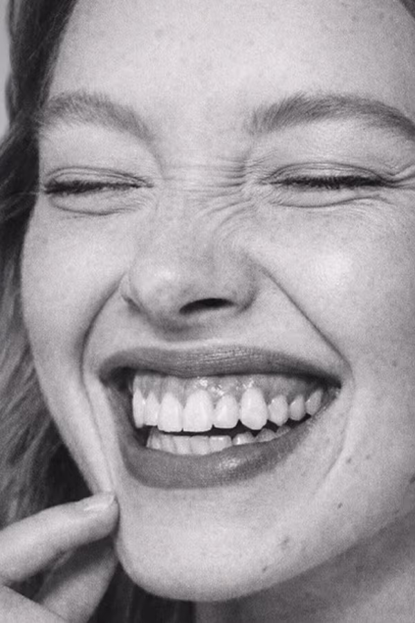 Black and white portrait representing gummy smile concern showing excess gum visibility at CAMI
