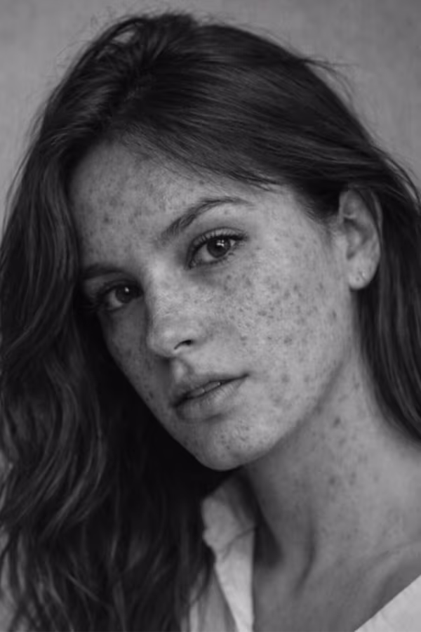 Black and white close-up representing acne scarring and post-inflammatory texture concern at CAMI