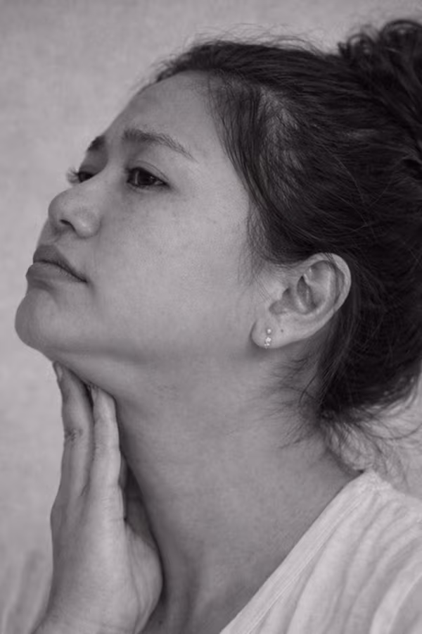 Black and white portrait representing double chin and submental fullness concern at CAMI