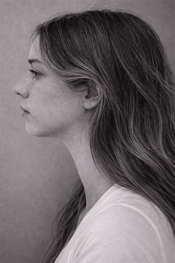Black and white portrait representing weak chin and undefined jawline structural concern at CAMI