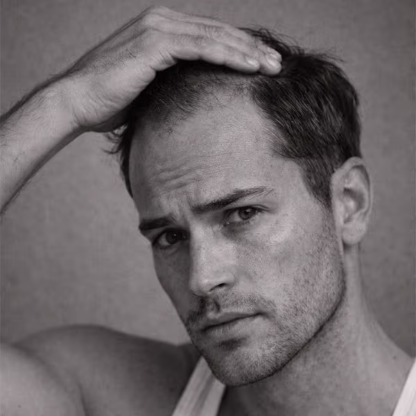 Black and white portrait representing male hair loss and thinning hairline concern at CAMI