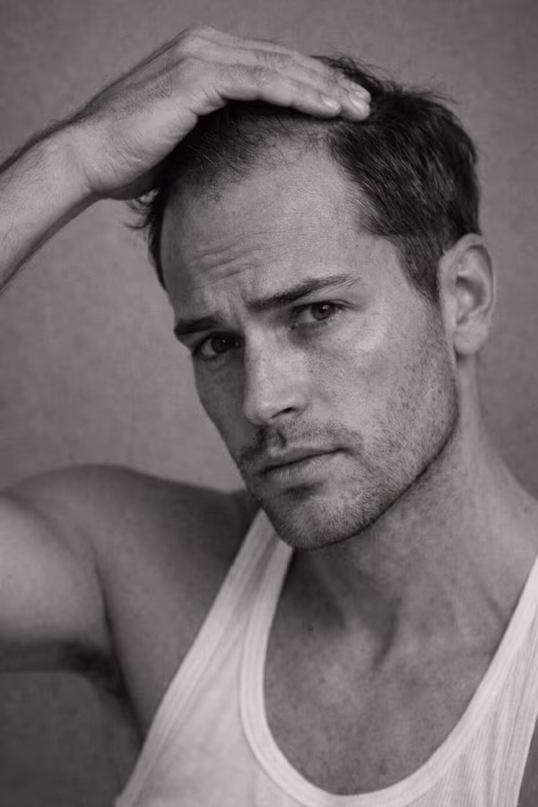 Black and white portrait representing male hair loss and thinning hairline concern at CAMI