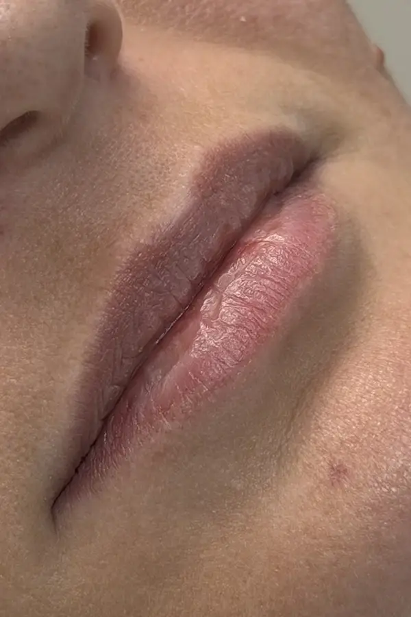 Before lip filler at CAMI — thin lips with minimal definition and volume