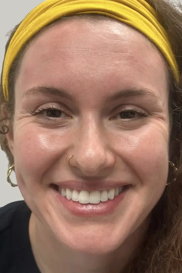 Before wrinkle relaxers at CAMI — crow's feet and forehead expression lines visible at rest
