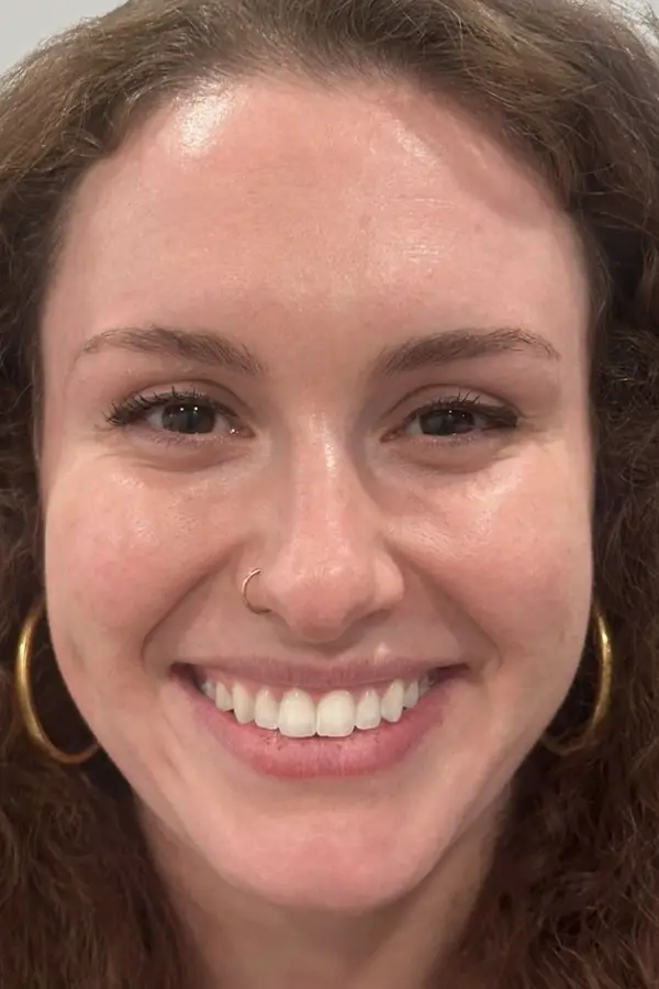 After wrinkle relaxers by Katie Wilson RN at CAMI — softened crow's feet and forehead lines