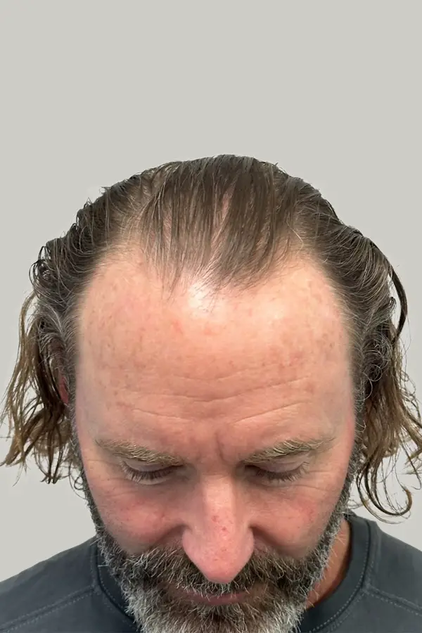 Before male hair loss treatment at CAMI — thinning hairline with reduced density