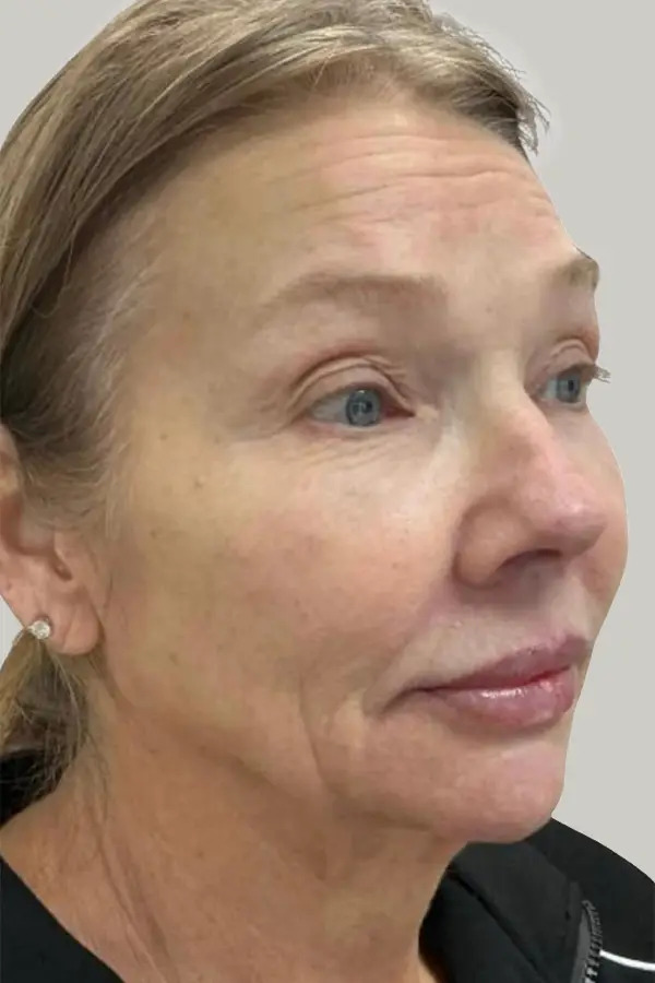 Before full face filler treatment at CAMI — volume loss across jawline, temples, and midface with visible aging