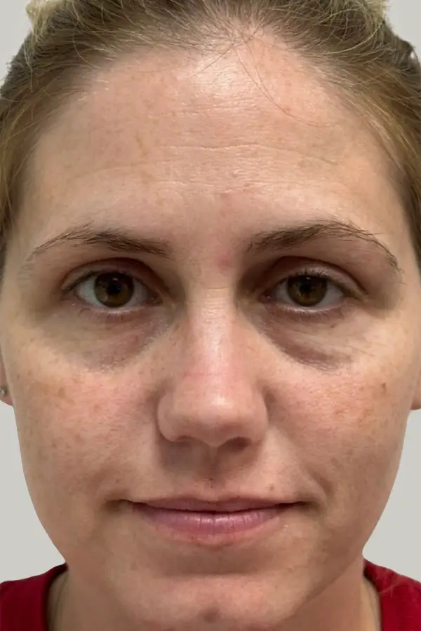 Before filler treatment at CAMI — hollow under eyes, volume loss across the midface and upper face