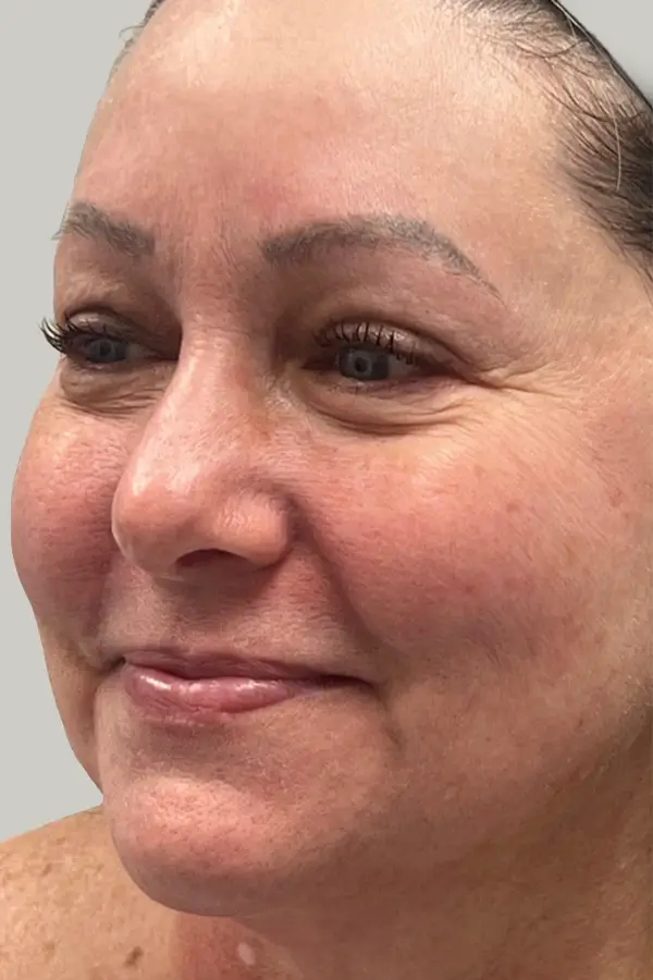 After BBL photofacial by Madison Mikolajczyk RN at CAMI — reduced sun damage and more even skin tone
