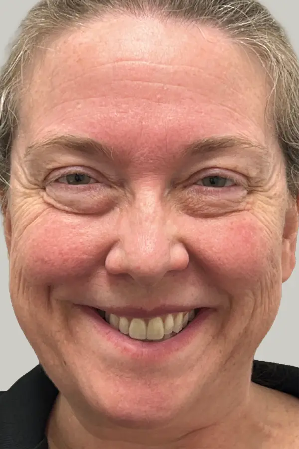 Before wrinkle relaxer treatment at CAMI — visible forehead lines, crow's feet, and expression lines at rest
