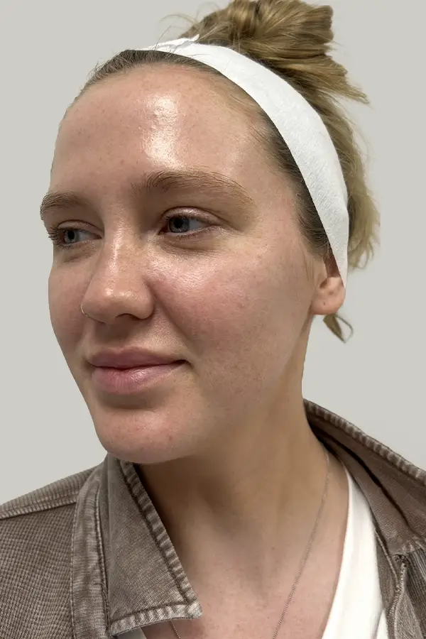 meredith-microneedling
